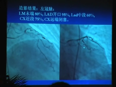 [GWICC2009]左主干“慢闭”介入一例          